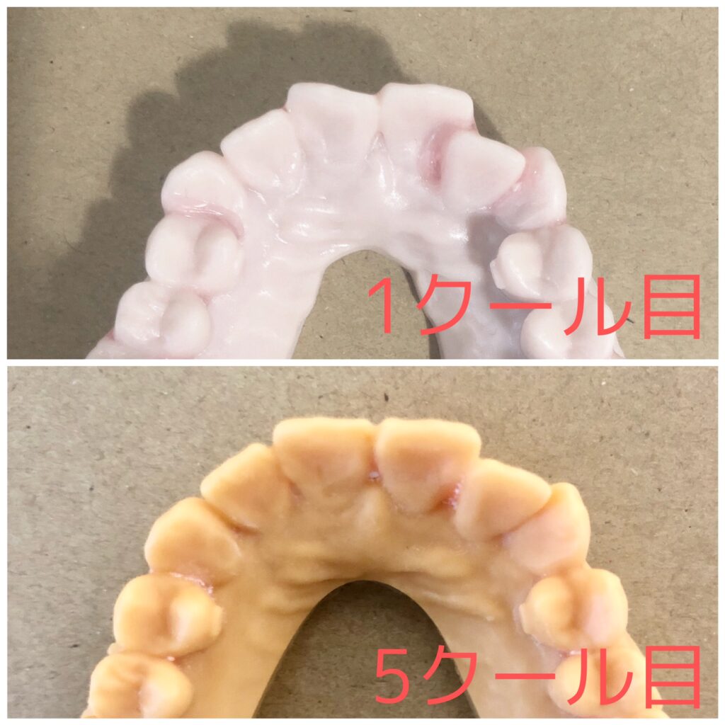 キレイライン矯正変化の比較1クール目と5クール目（上あご）