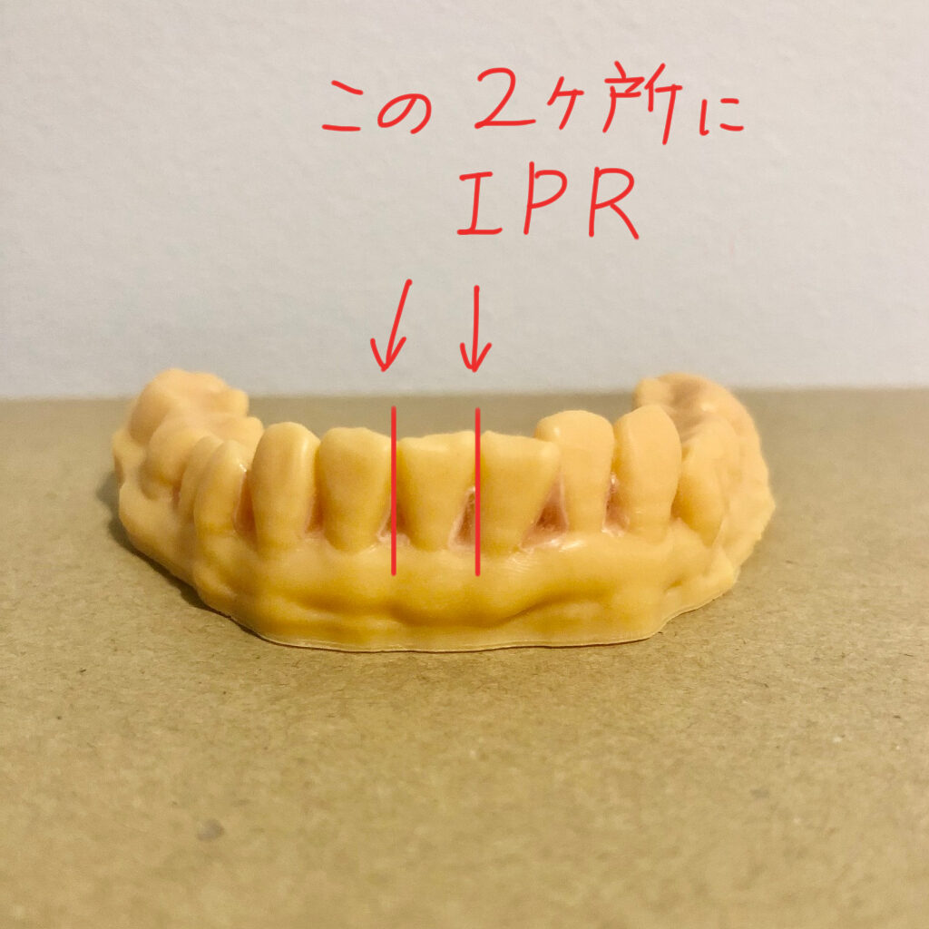 IPRを行った歯型